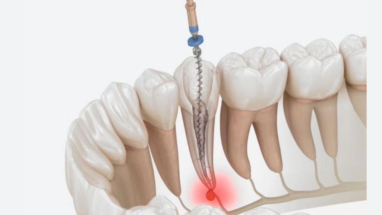 What Happens If You Get an Infection After a Root Canal in Older Adults
