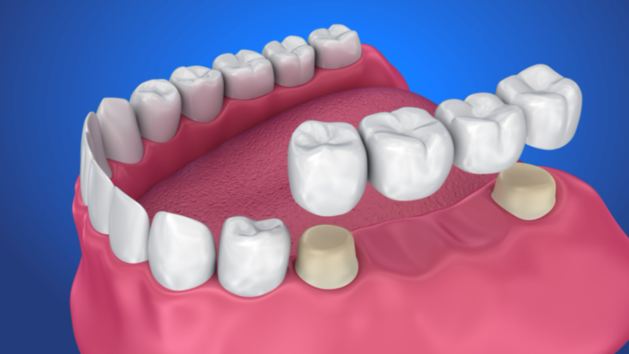 How Long Do Dental Bridges Typically Last?