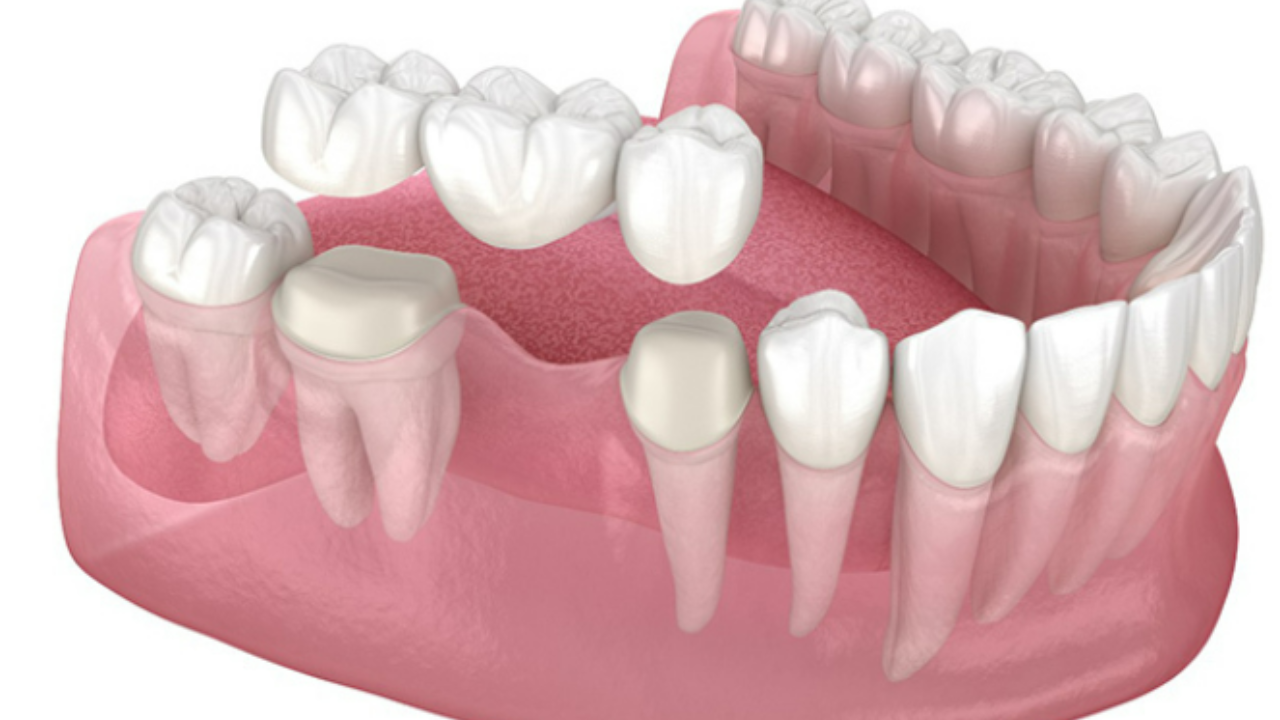 Are Dental Bridges Permanent or Removable? Understanding Your Options
