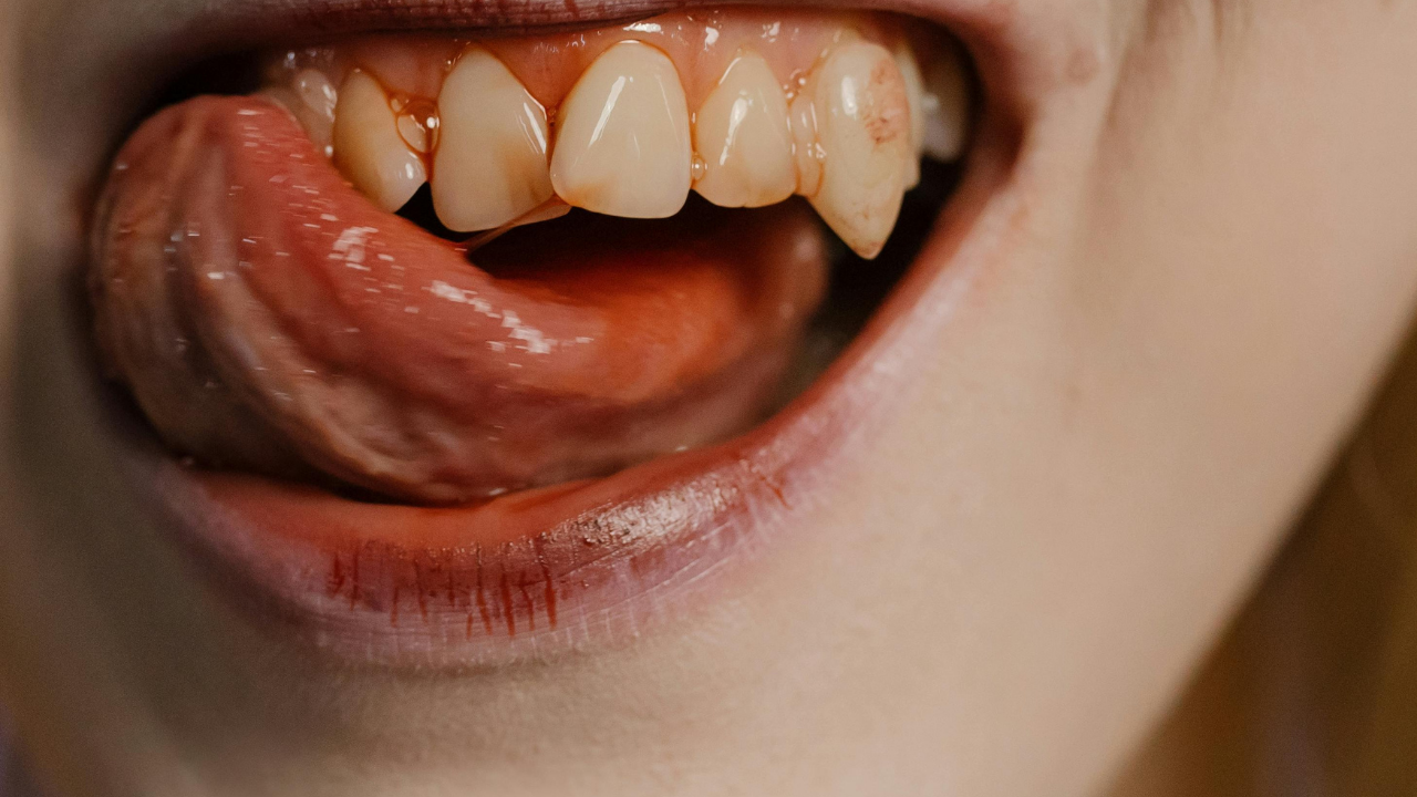 Why Are My Gums Bleeding When I Brush? Causes and Solutions