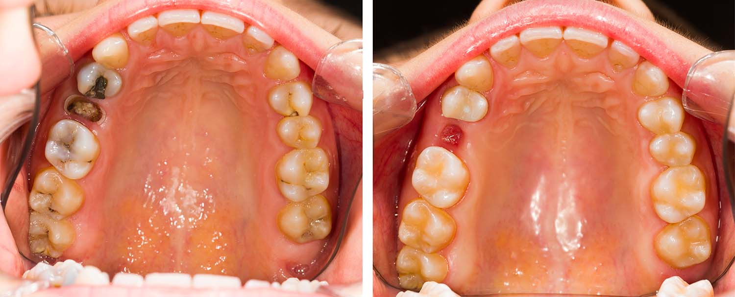 How Long Does It Take for Gums to Heal After a Tooth Extraction?